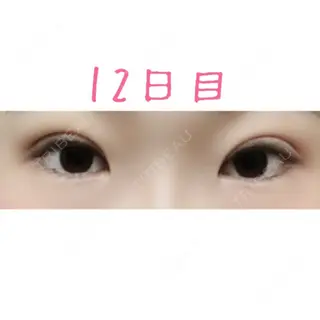 12日目の経過画像（1枚目）