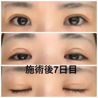 7日目の経過画像（1枚目）