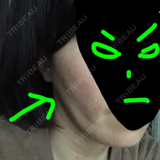 32日目の経過画像（1枚目）