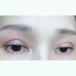 96日目の経過画像（3枚目）