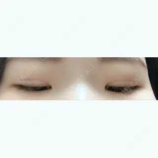 30日目の経過画像（2枚目）