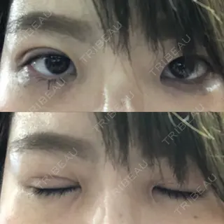 1日目の経過画像（1枚目）