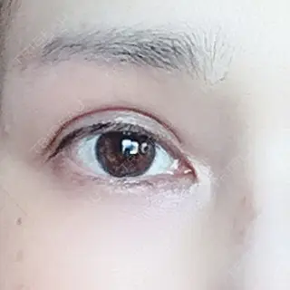 99日目の経過画像（1枚目）