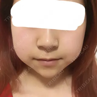 8日目の経過画像（1枚目）
