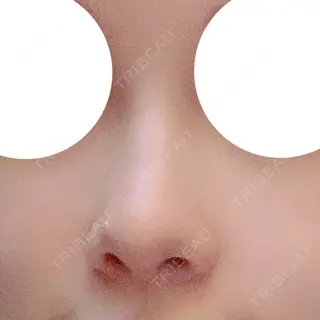 183日目の経過画像（1枚目）