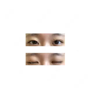 115日目の経過画像（1枚目）