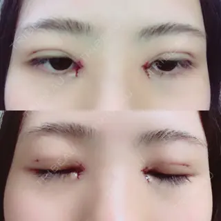 0日目の経過画像（1枚目）