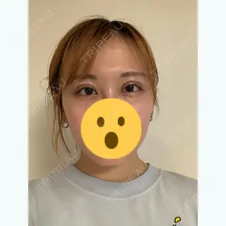 23日目の経過画像（1枚目）