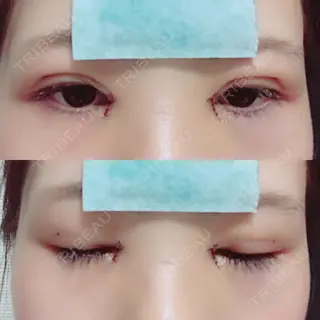 2日目の経過画像（1枚目）