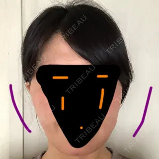38日目の経過画像（1枚目）
