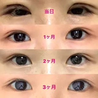 90日目の経過画像（1枚目）