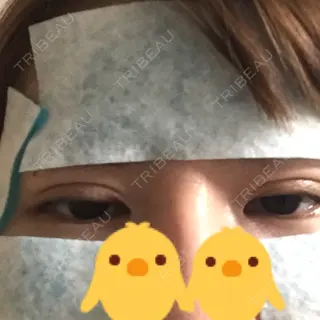 0日目の経過画像（1枚目）
