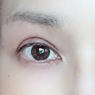 105日目の経過画像（1枚目）