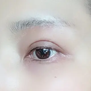105日目の経過画像（3枚目）