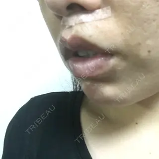 6日目の経過画像（2枚目）