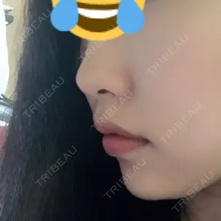 0日目の経過画像（1枚目）