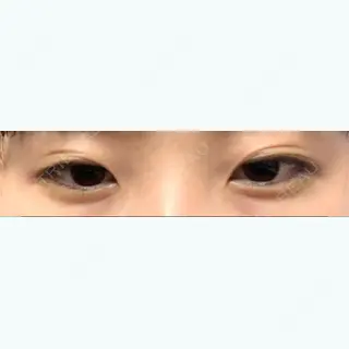 66日目の経過画像（2枚目）
