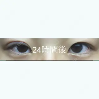 1日目の経過画像（1枚目）