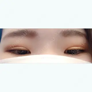 44日目の経過画像（3枚目）