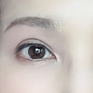 110日目の経過画像（1枚目）