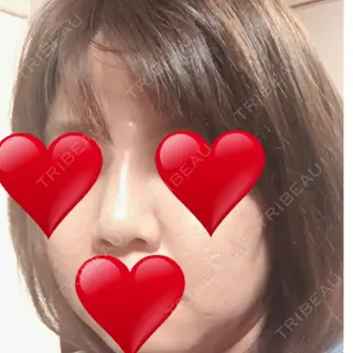 13日目の経過画像（1枚目）
