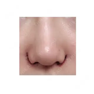 0日目の経過画像（1枚目）