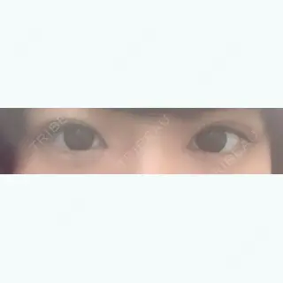 32日目の経過画像（1枚目）