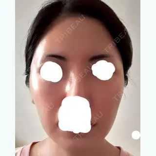 106日目の経過画像（1枚目）