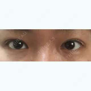5日目の経過画像（1枚目）