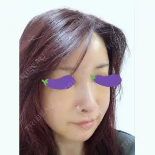 8日目の経過画像（2枚目）
