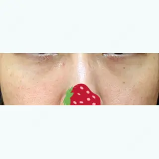 46日目の経過画像（1枚目）