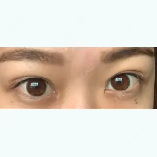 64日目の経過画像（1枚目）