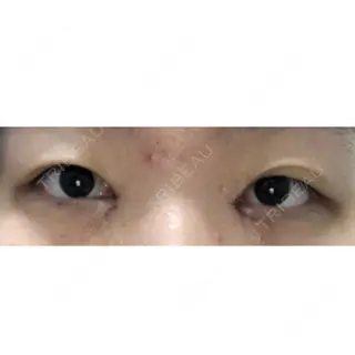 2日目の経過画像（2枚目）