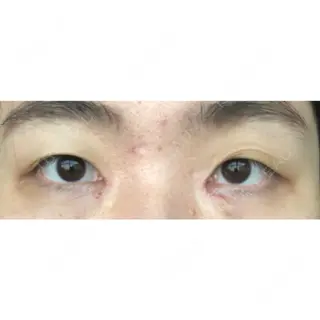 5日目の経過画像（2枚目）