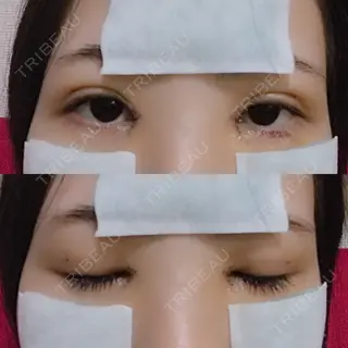 6日目の経過画像（1枚目）