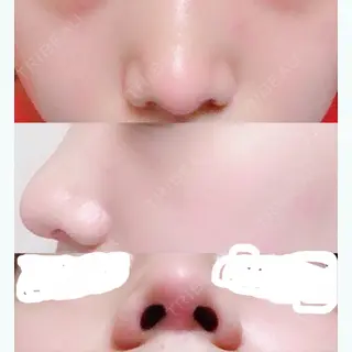 36日目の経過画像（1枚目）