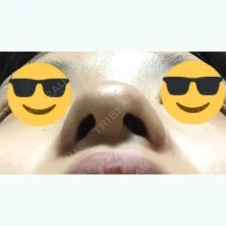 98日目の経過画像（3枚目）