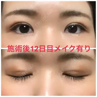 12日目の経過画像（2枚目）