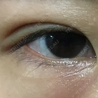 8日目の経過画像（1枚目）