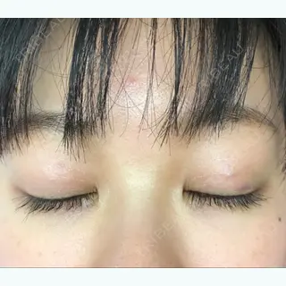 11日目の経過画像（3枚目）