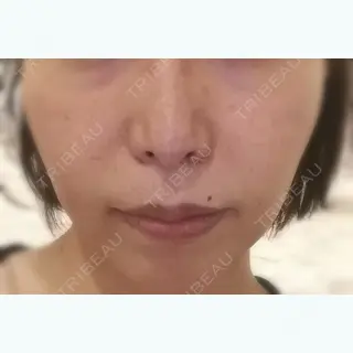166日目の経過画像（1枚目）
