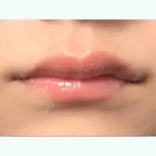 4日目の経過画像（1枚目）