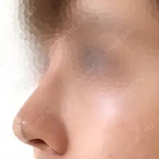 3日目の経過画像（2枚目）