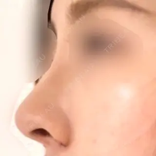 5日目の経過画像（3枚目）