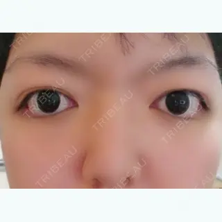 4日目の経過画像（3枚目）