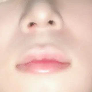 6日目の経過画像（2枚目）