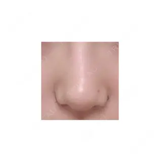 6日目の経過画像（1枚目）