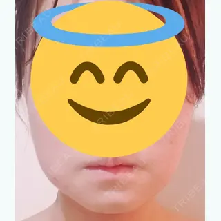 68日目の経過画像（1枚目）