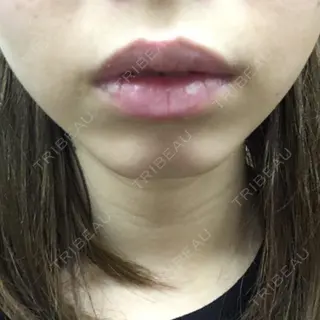 3日目の経過画像（1枚目）
