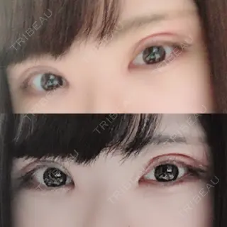 14日目の経過画像（3枚目）